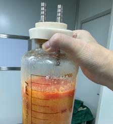 瑞安水动力吸脂手术要做多久？